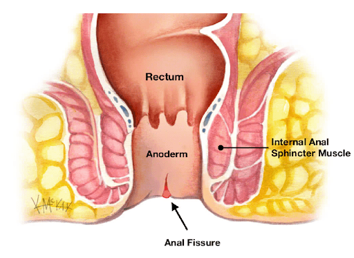 Fissure Treatment In Pune
Best Treatment For Fi... main image