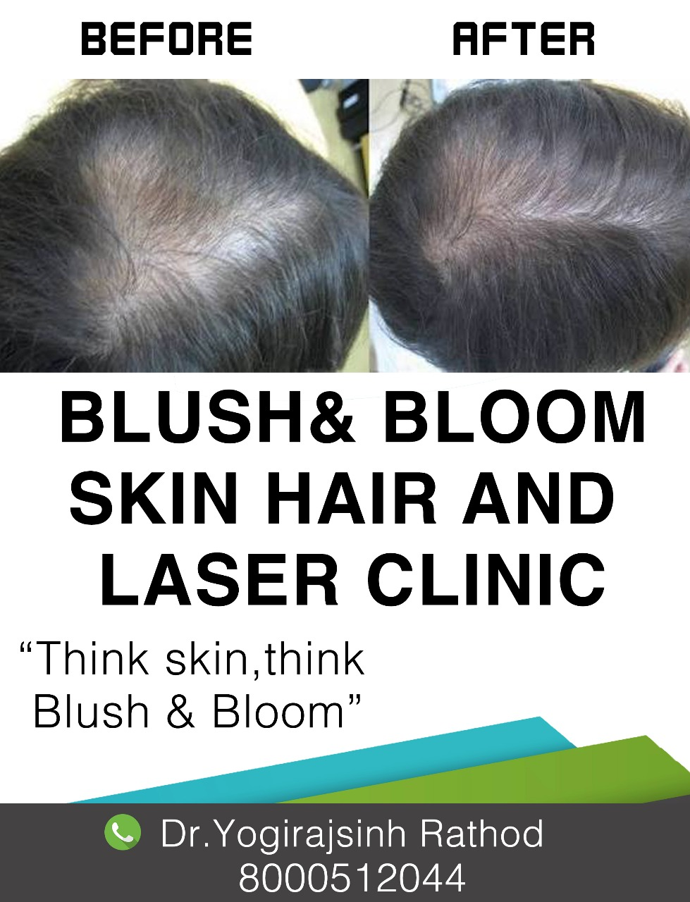Hair loss is a common problem that affects mill... main image