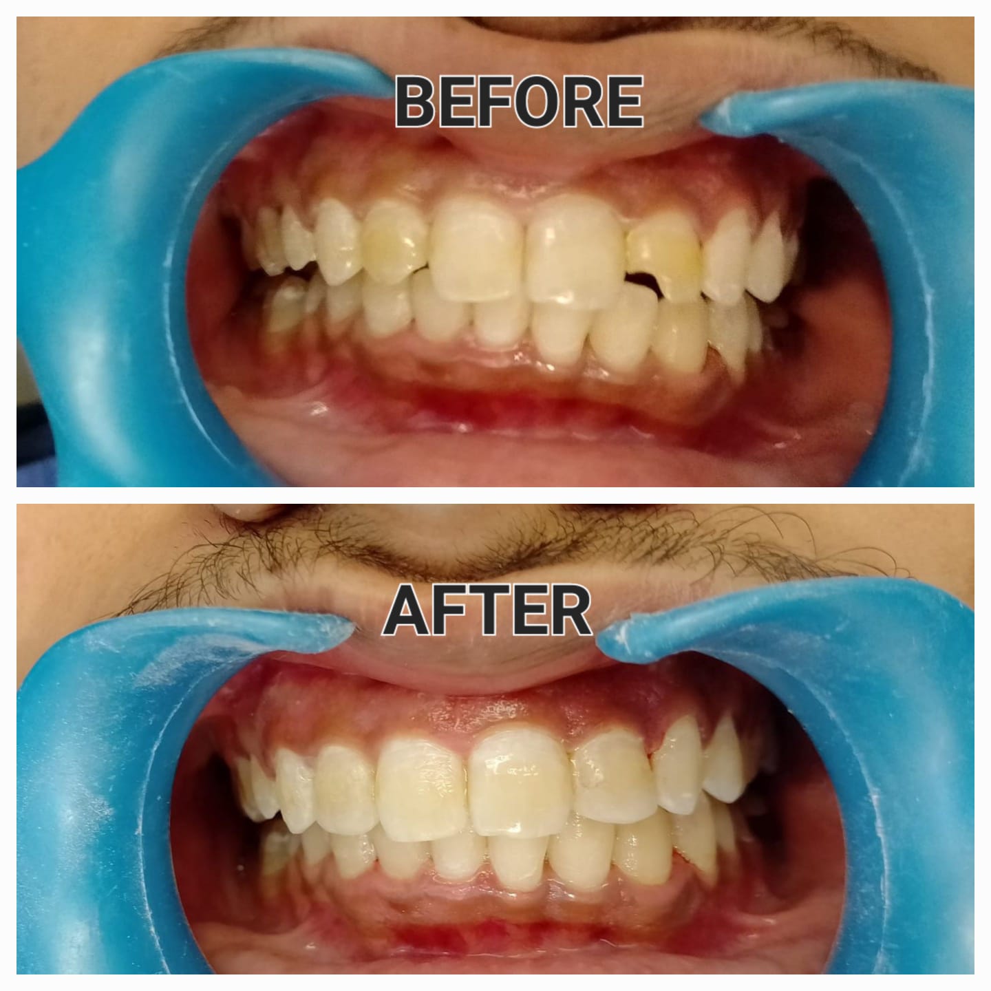 Fractured tooth??
Worried for your beautiful sm... main image