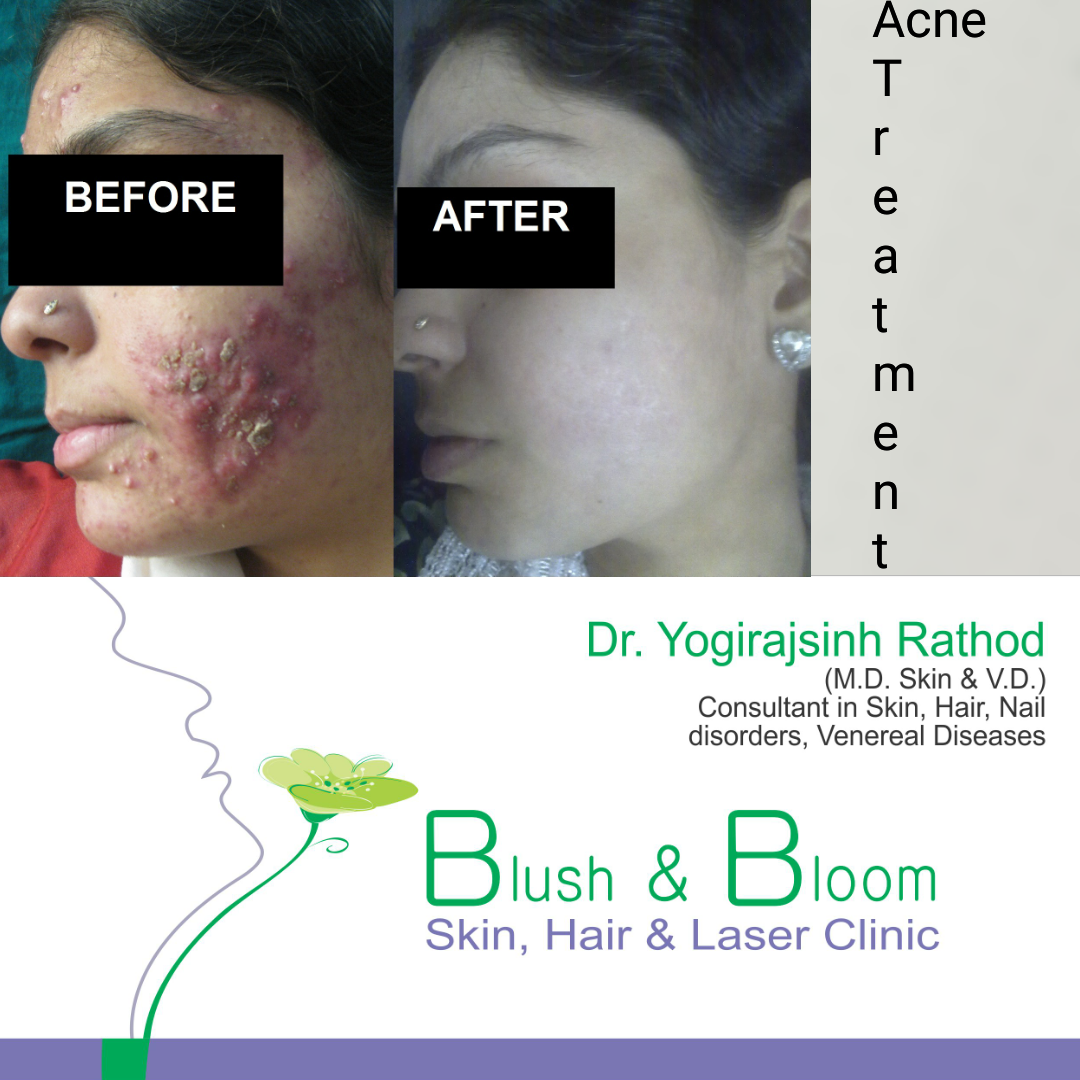 Acne is a common skin issue that affects people... main image