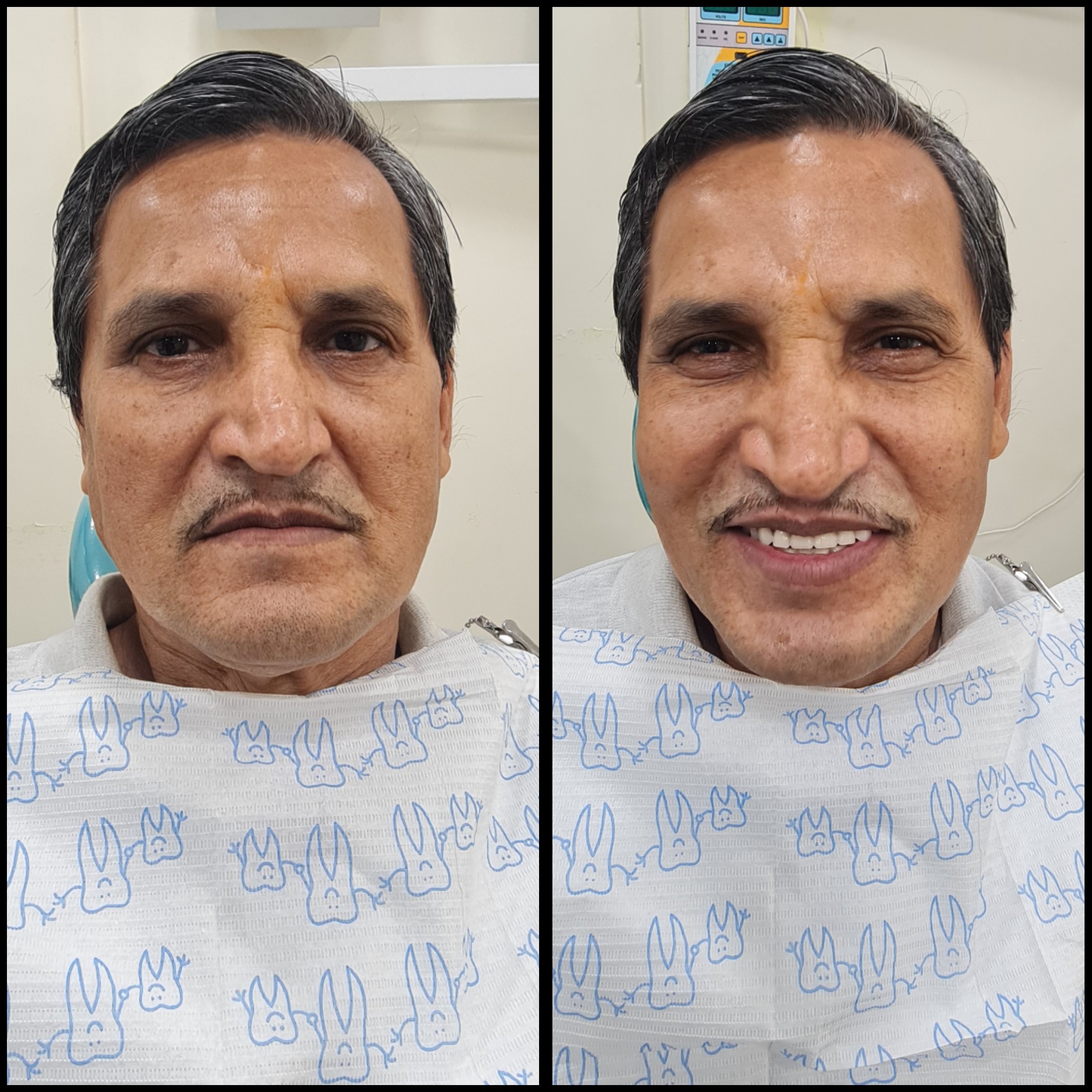 Missing teeth affect the chewing function, esth... main image