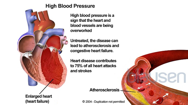 Ayurvedic treatment for BP ( Blood Pressure ) i... main image