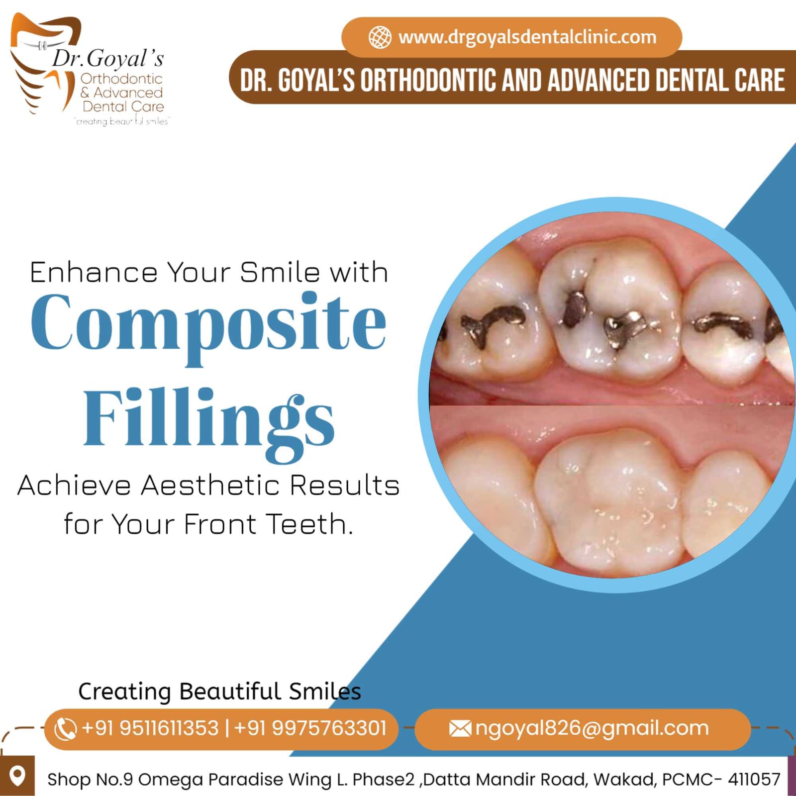 Composite fillings also known as tooth colored ... main image