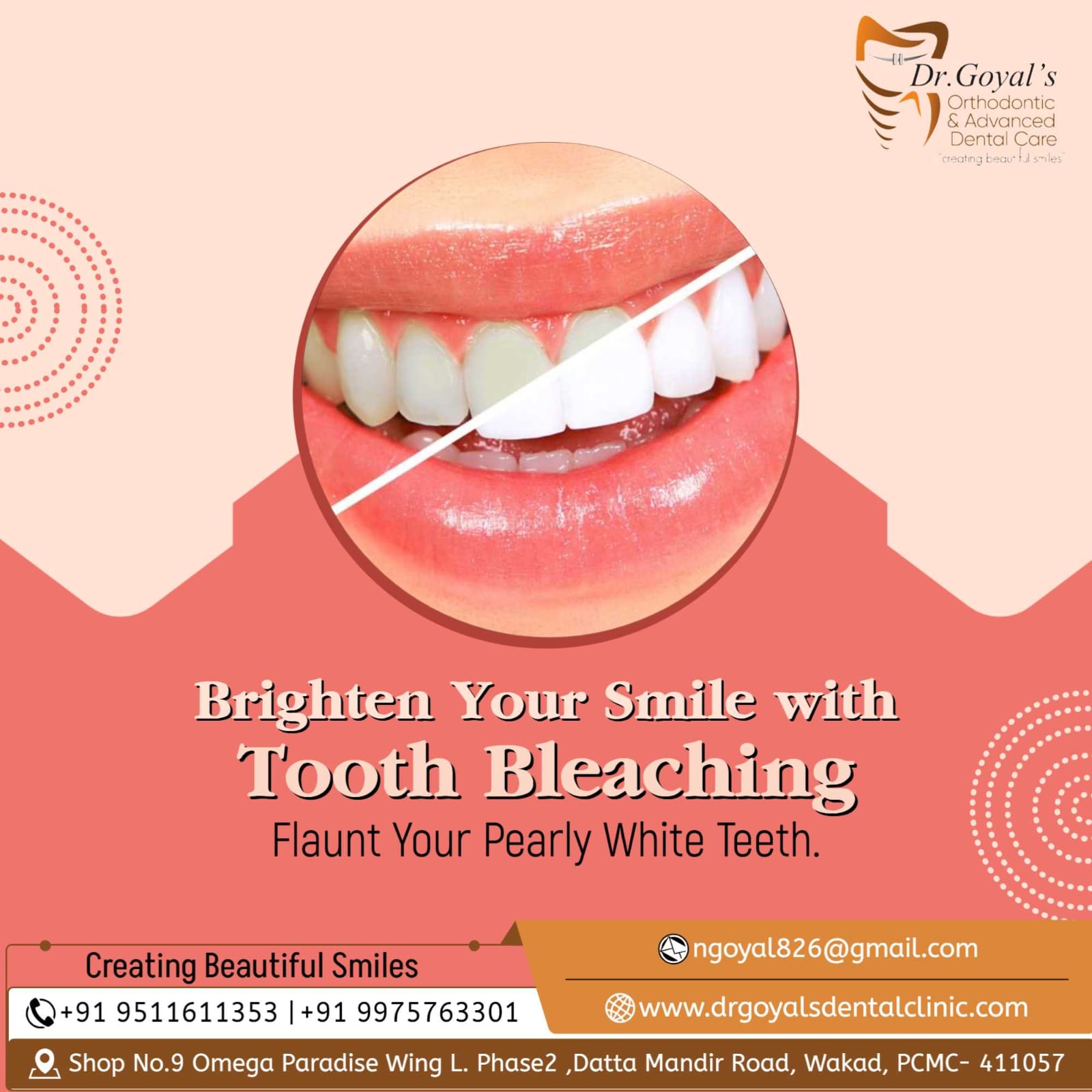 Tooth bleaching is the most common procedure in... main image