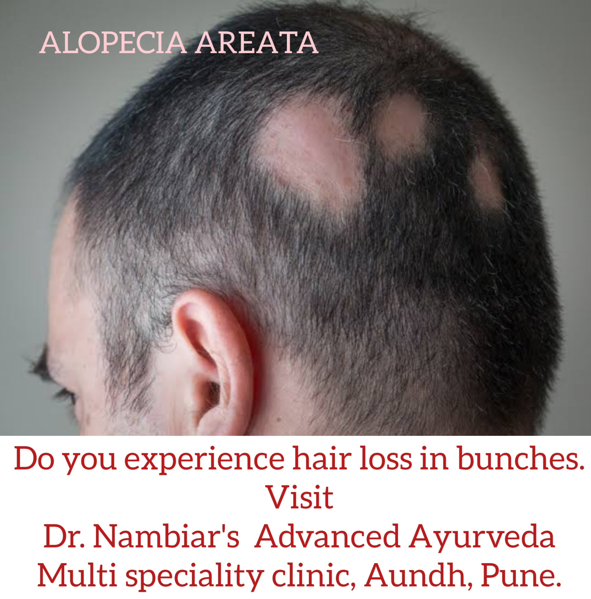 Alopecia Areata Causes Symptoms and Treatment