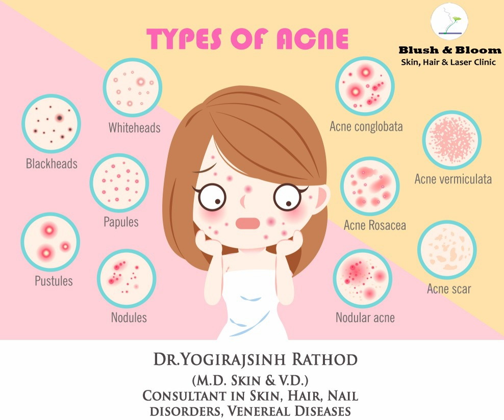 Acne is a common skin condition that affects mi... main image