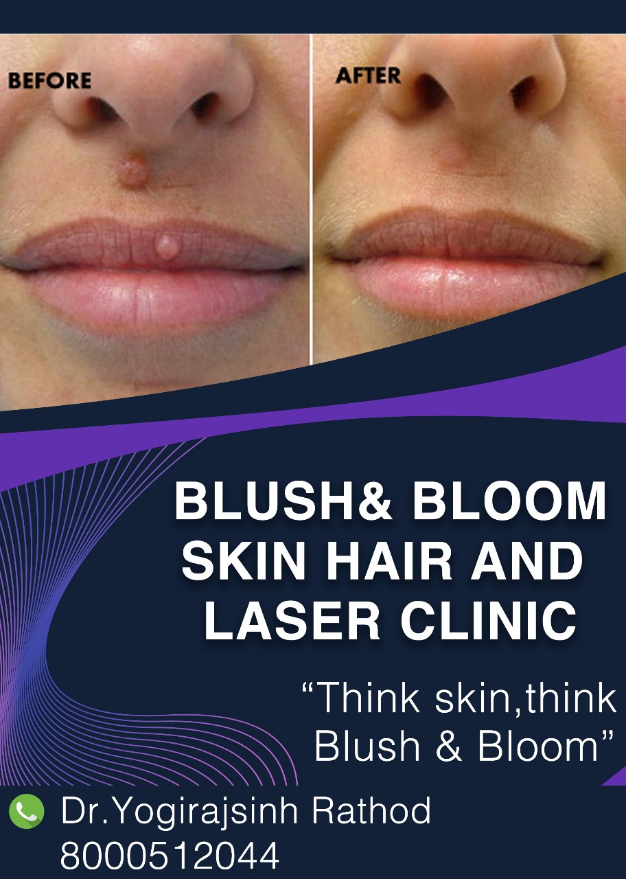 Moles are a common skin condition that affects ... main image
