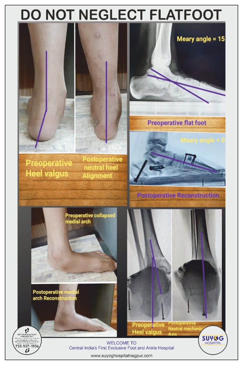 Best foot and ankle doctor in Nagpur