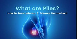 Experience relief from piles and related condition... main image