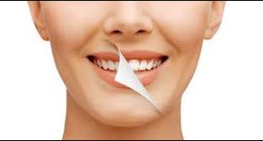 Smile Makeover at Ka