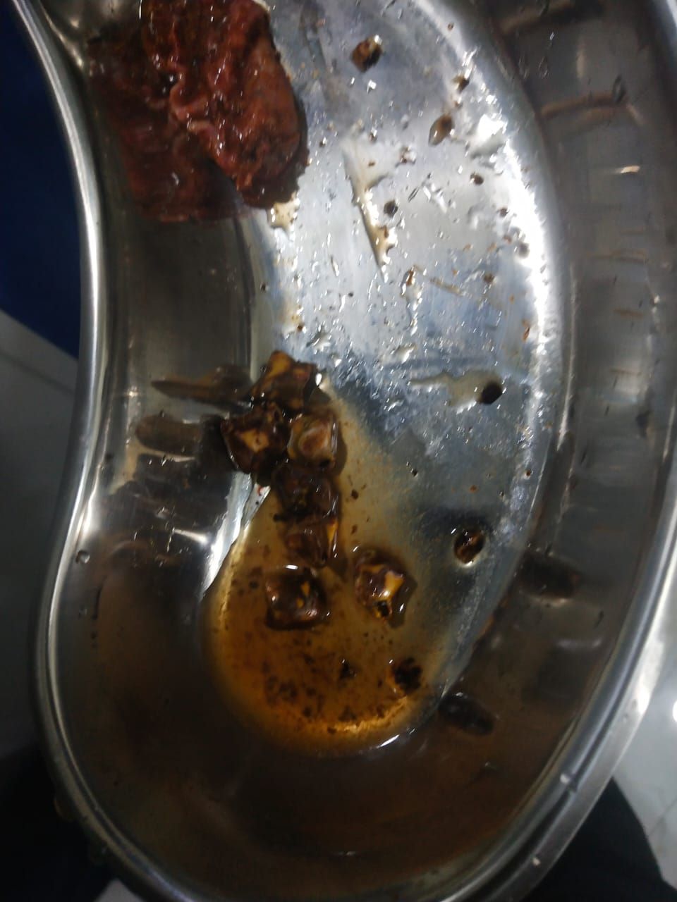 MULTIPLE GALL STONES REMOVED BY LAPROSCOPIC CHOLEC... main image