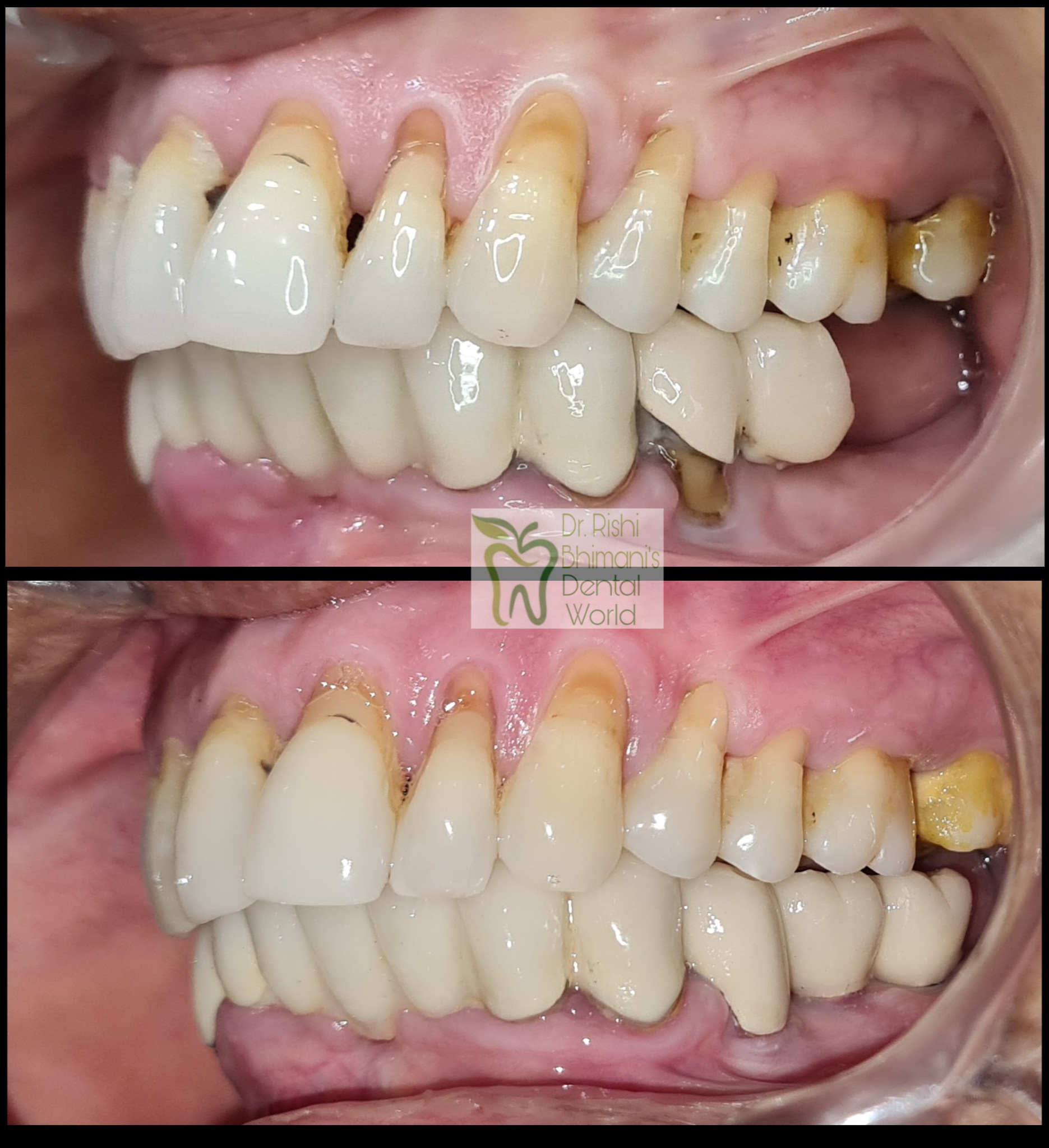 MISSING TEETH can adversely hamper the chewing ... main image