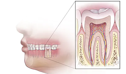 Root Canal Treatment