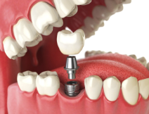 Dental Implants at K