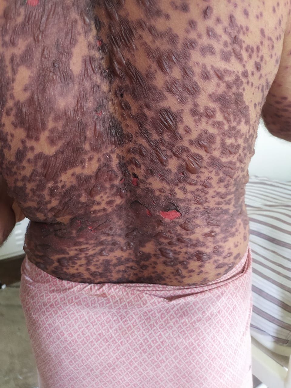 STEVEN JOHNSON SYNDROME PT ADMITTED AT OUR HOSPITA... main image