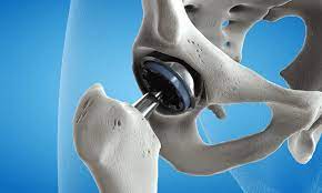 Hip Replacement In Nagpur . Hip Replacement
Hip... main image
