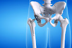 Nowadays, Joint replacement surgery is not a te... main image