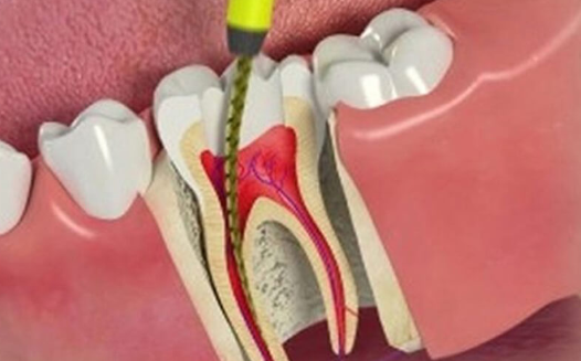 ROOT CANAL TREATMENT
