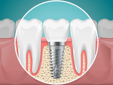 DENTAL IMPLANT Denta