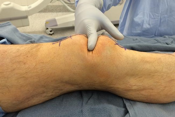 Knee Fracture
A patellar fracture is a break in... main image