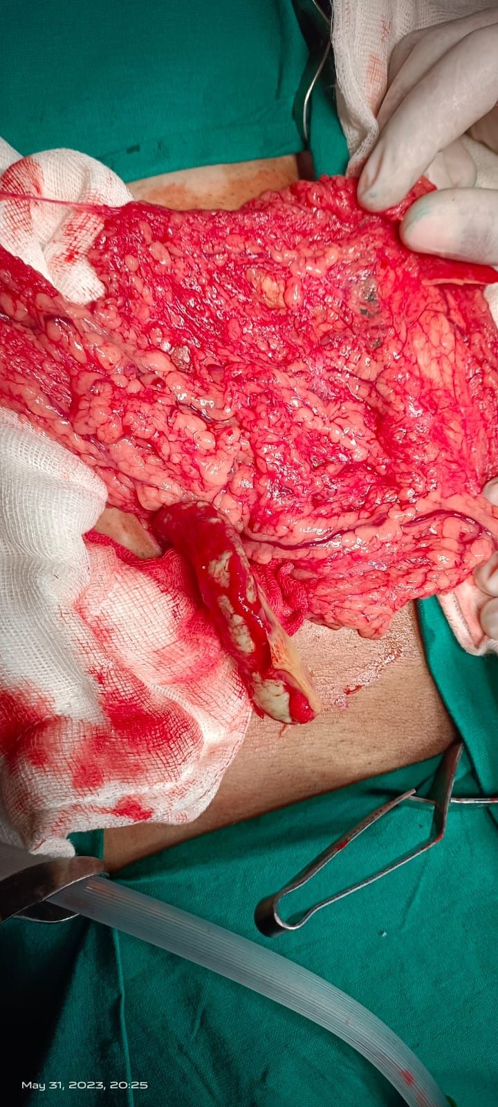 Gangrenous perforated appendix operated at Integri... main image