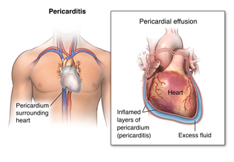 Pericarditis Treatment ( Heart disease ) 
Peric... main image