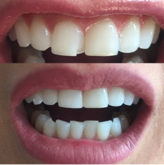 Dental Bonding Denta