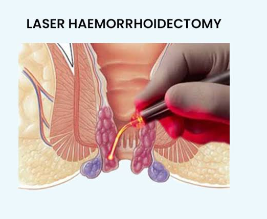The laser hemorrhoids surgery helps in minimizi... main image