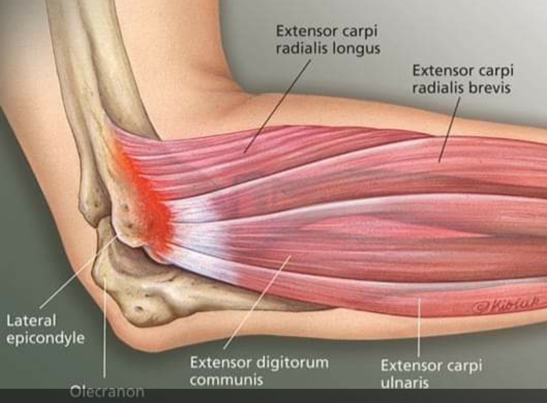 Tennis elbow or lateral epicondylitis is a orth... main image