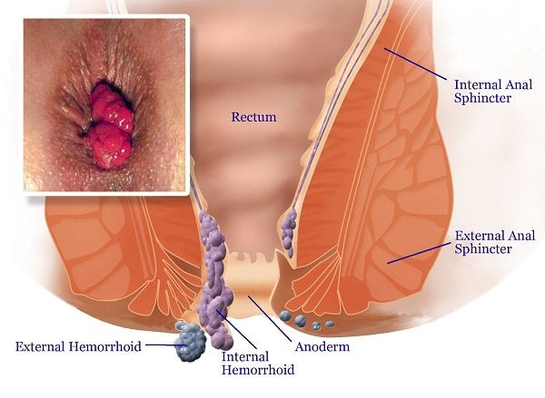 Ayurvedic Piles Treatment In Dayari
Ayurvedic P... main image