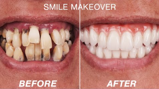 SMILE MAKEOVER A smi