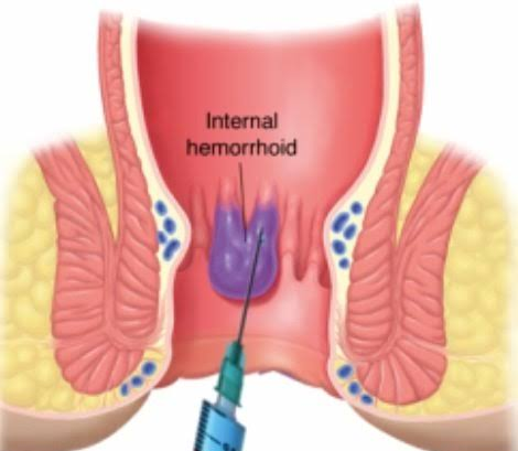 Internal hemorrhoids lie inside the rectum. You... main image