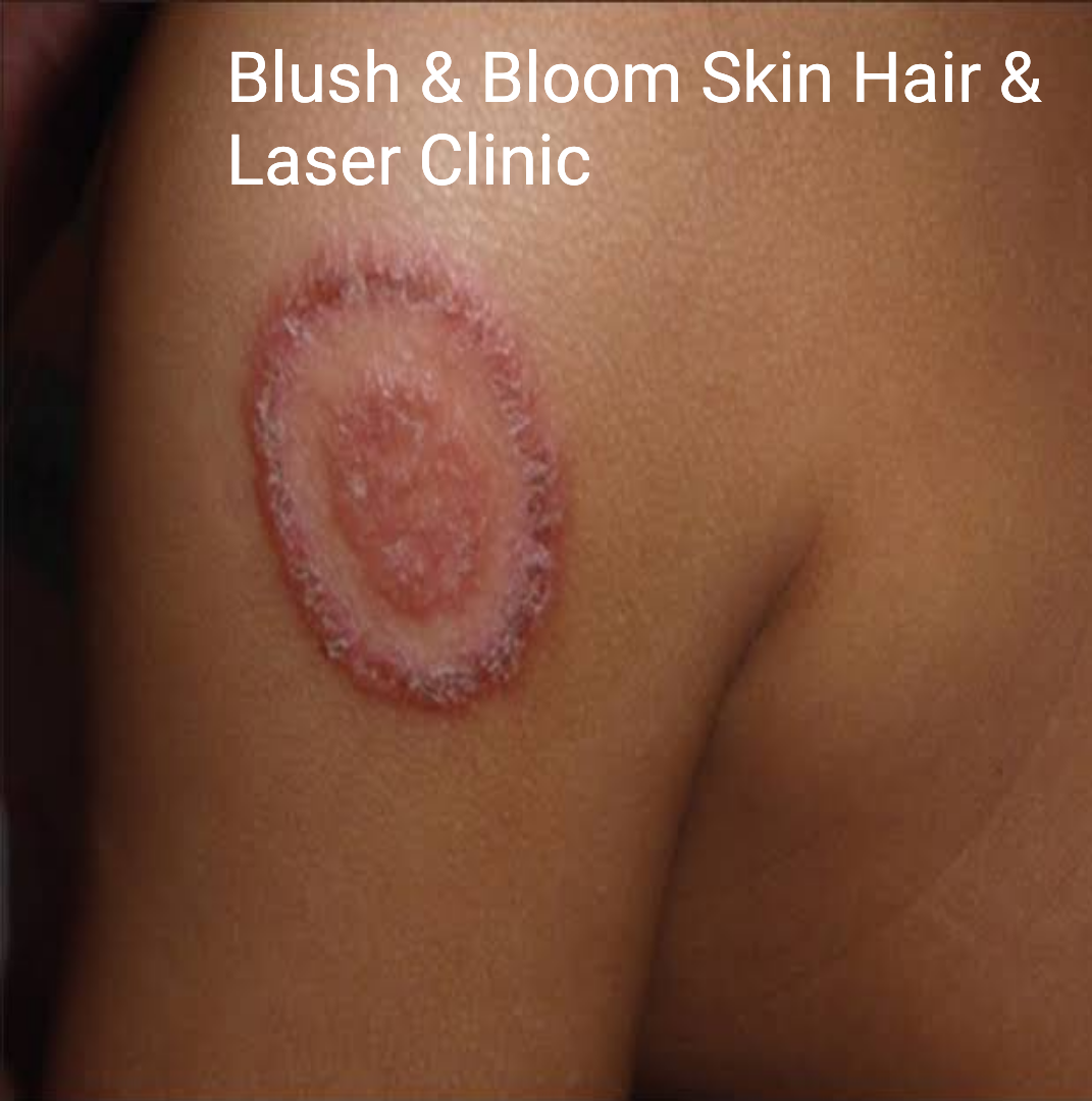 Fungal infections have become a growing concern... main image