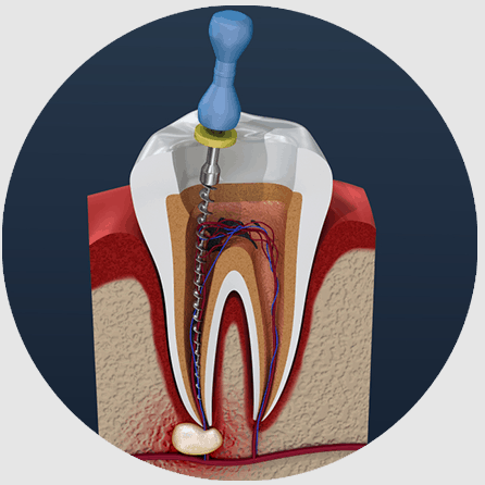 ROOT CANAL TREATMENT