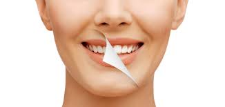 Smile Makeover - Enh