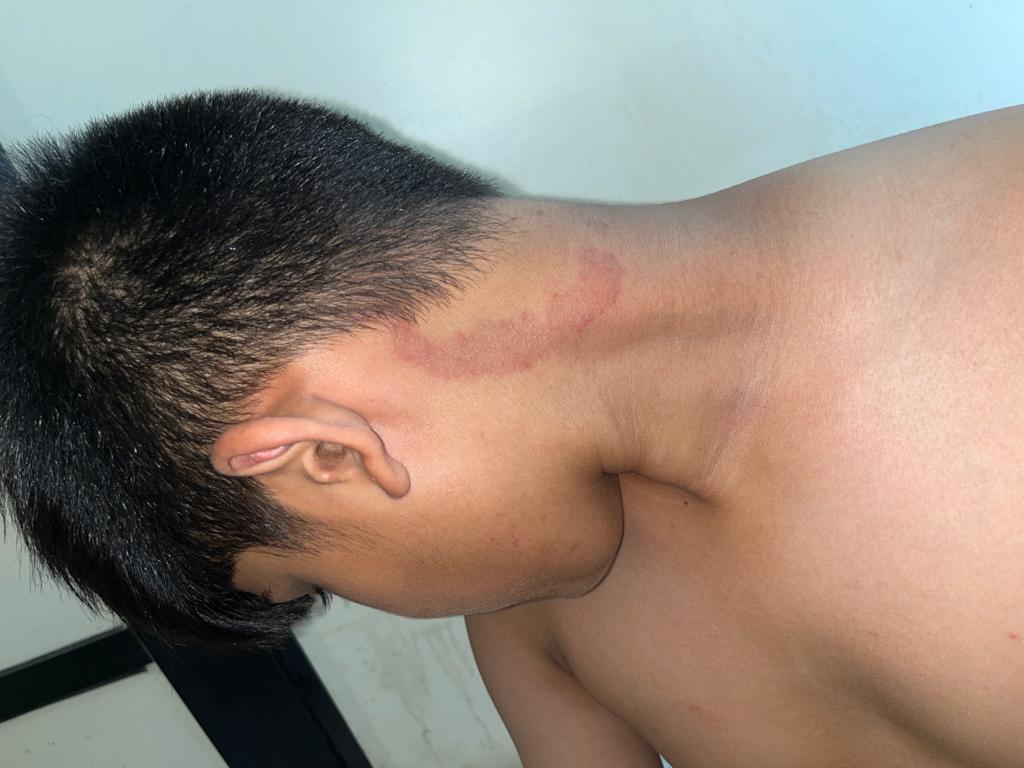 fungal infection on skin
Ayurvedic Treatment Fo... main image