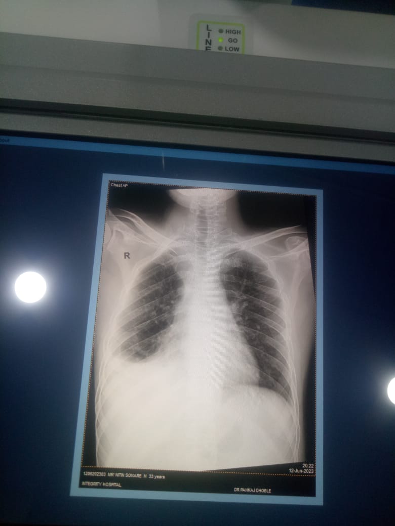 RIGHT PLEURAL EFFUSION 
PATIENT AT INTEGRITY SU... main image