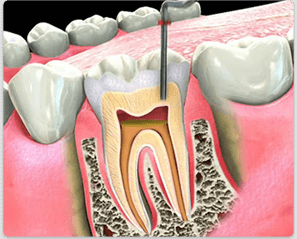Root Canal Treatment