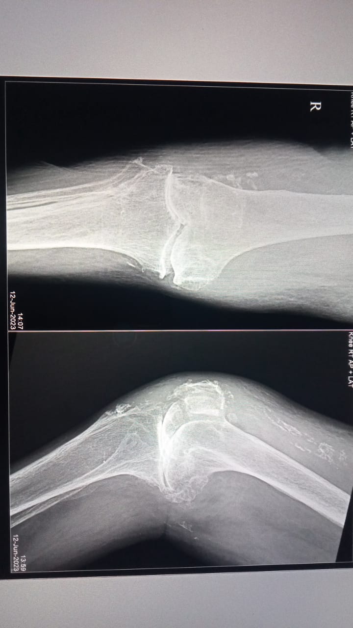 SEVERE OSTEOARTHRITIS
PT WITH SEVERE KNEE JOINT... main image