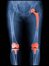 Joint Replacement - Fostering Mobility and Quality... main image