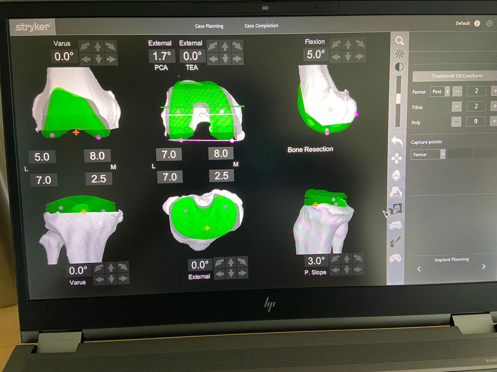 Knee replacement surgery is one of the best tre... main image