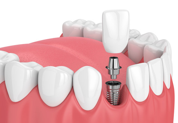 Dental Implants - Re