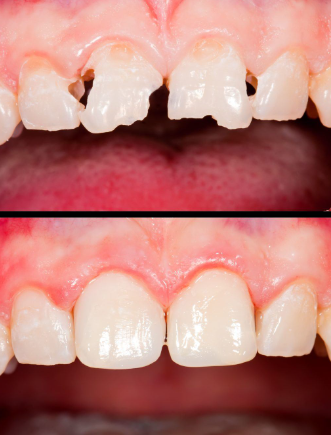 Dental Bonding - Enh