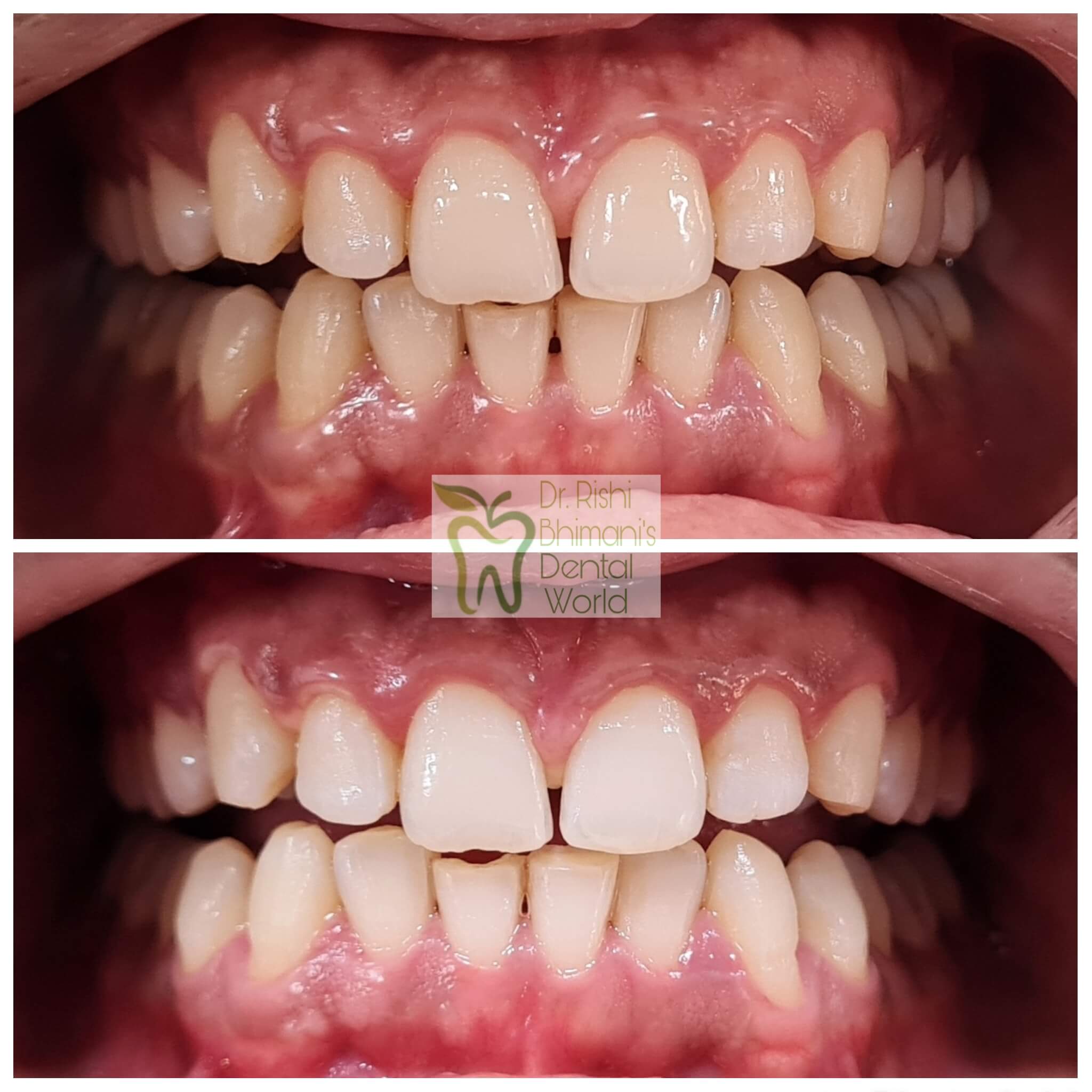 Teeth Whitening or Bleaching
Instant Teeth Whit... main image