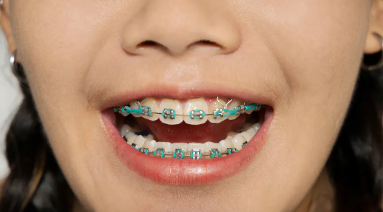 Dental Braces - Stra