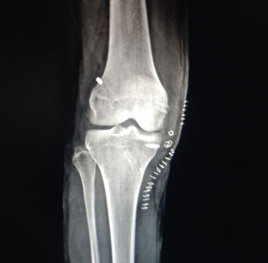 Sports injury is one of the major injuries . Kn... main image