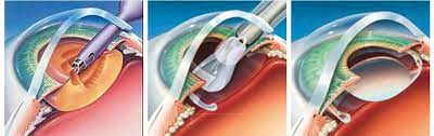 Regain Crystal Clear Vision with Precision at G... main image
