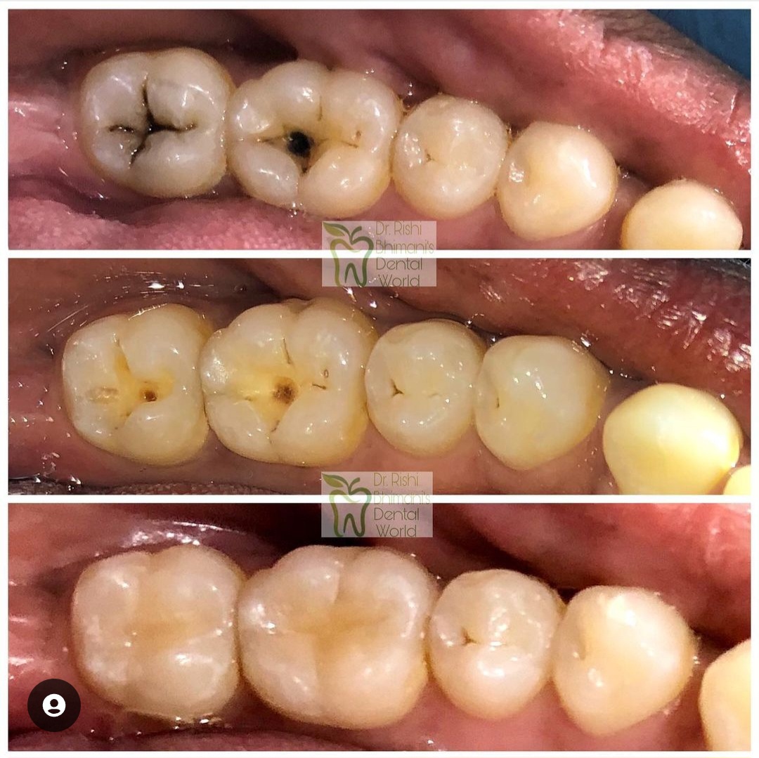 Tooth decay is a process by which strong hard t... main image