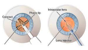 Embark on a Journey to Crystal Clear Vision at Gre... main image