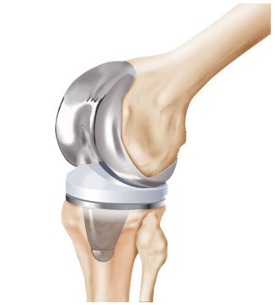Welton Hospital: Transforming Lives with Knee R... main image